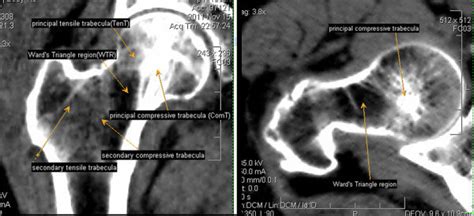 The location of the trabeculae and Ward's Triangle region internal ...