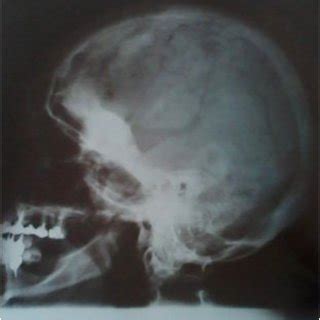 -Preoperative skull X-ray showing hyperostosis of the right sphenoid... | Download Scientific ...