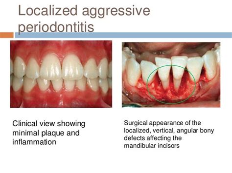 Aggressive periodontitis