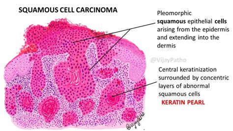 Pathology of SQUAMOUS CELL CARCINOMA - Pathology Made Simple