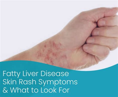 Connecting the Dots: Skin Rashes and Fatty Liver Disease - LiverSupport.com