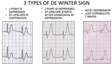 de Winter Sign - EMERGENCY MEDICINE GUIDEWIRE