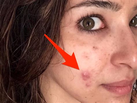 A dermatologist shared photos of her cystic acne on Instagram - Business Insider