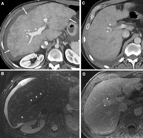 A, B Patient with congestive hepatopathy and periportal edema. Portal... | Download Scientific ...