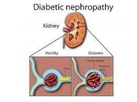 Diabetic nephropathy - Health Tips, Diabetic nephropathy Health ...