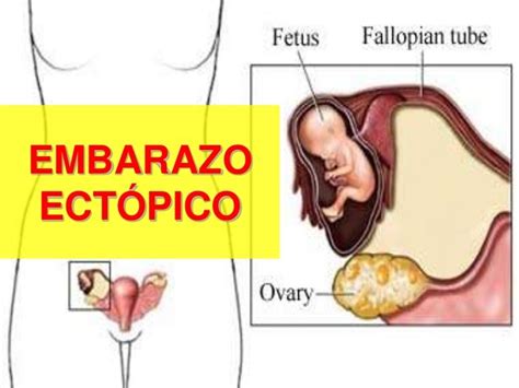 Aula 2 embarazo ectópico