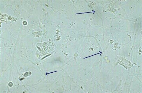 Mucus thread | Medical laboratory, Medical laboratory technician ...