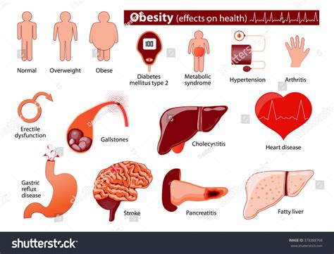 Obesity Overweight Infographic Effects On Health Stock Vector (Royalty ...