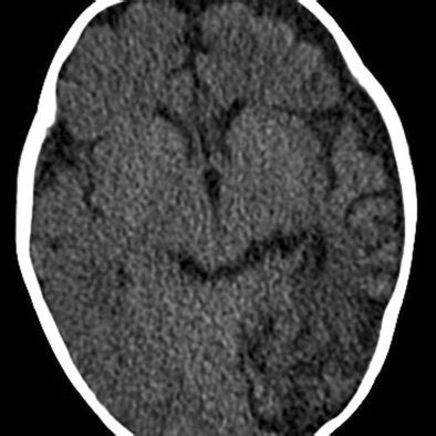 The Big Black Brain: Subdural Hemorrhage with Hemispheric Swelling and Low Attenuation | Request PDF