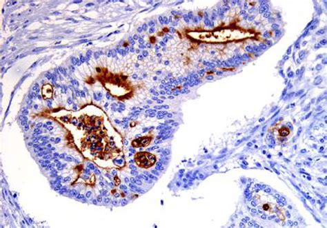 PANCREATIC CANCER :: Molecular pathology of pancreatic diseases