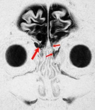 Cerebrospinal Fluid Leak Imaging: Practice Essentials, Computed Tomography, Magnetic Resonance ...