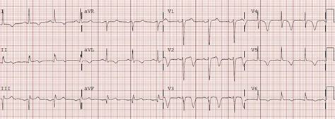 Dr. Smith's ECG Blog: Classic Evolution of Wellens' T-waves over 26 hours