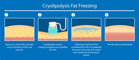 What are Fat Freezing Devices and Is It Safe to Use at Home? - Tummy Tucks in Singapore