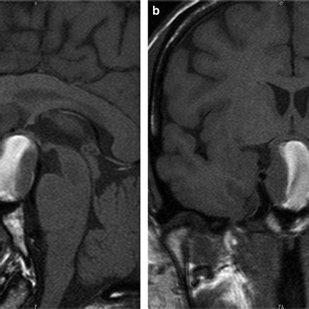 Parasagittal and coronal T1-weighted nonenhanced MRI showing a 3 2.3 cm ...