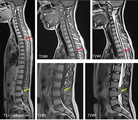 Two spinal lesions: schwannoma and meningioma – Radiology Cases