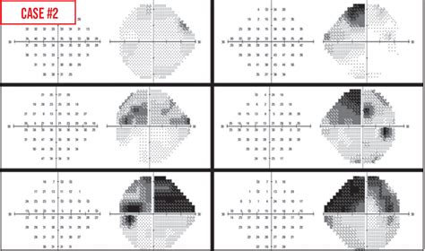 Recognizing Artifacts in Visual Field Testing