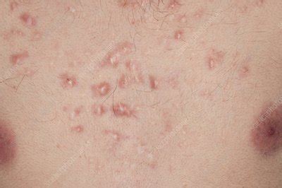 Keloid scarring from acne - Stock Image - C011/7380 - Science Photo Library