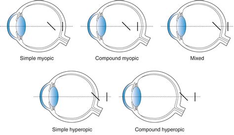 Astigmatism | Medical Junction