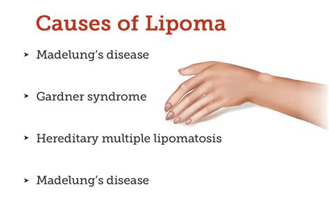 Lipoma: Symptoms, Causes, Treatment and Cost