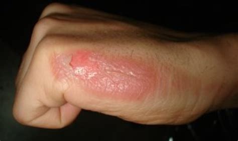 Types Of Burns And Their Treatment | HubPages