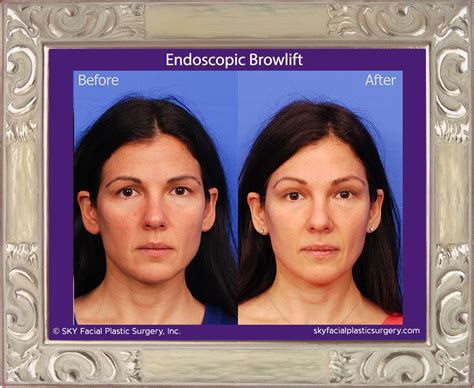 Browlift - San Diego's Best Browlift Surgeon — SKY Facial Plastic Surgery