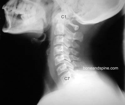 Normal Cervical Spine Xray | Bone and Spine