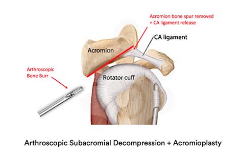 Subacromial Decompression & Acromioplasty | Shoulder Surgery | Sydney ...