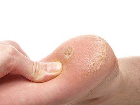 Calluses Removal Beaconsfield | Bucks Foot Clinic