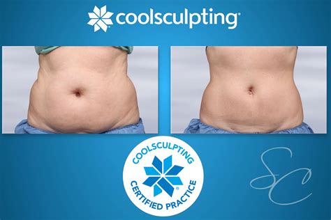 CoolSculpting – Southern California Surgical Center