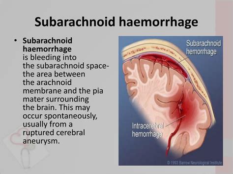 Subarachnoid Hemorrhage D27