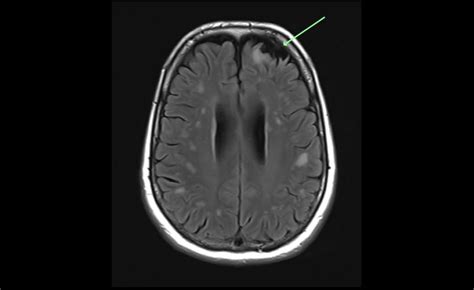 White Matter Hyperintensities on MRI: What Do They Signify?