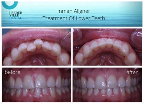 Before and after Inman Aligner used to straighten lower teeth at Leederville Dental ...