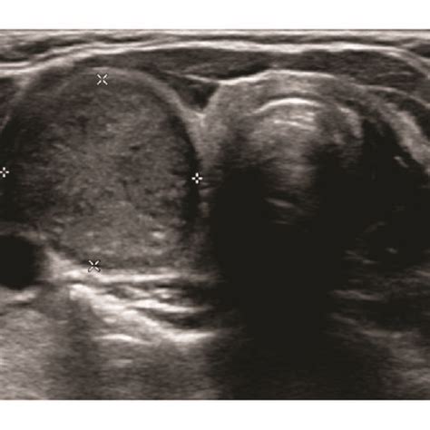 Thyroid ultrasound scan shows a round well circumscribed heterogeneous,... | Download Scientific ...