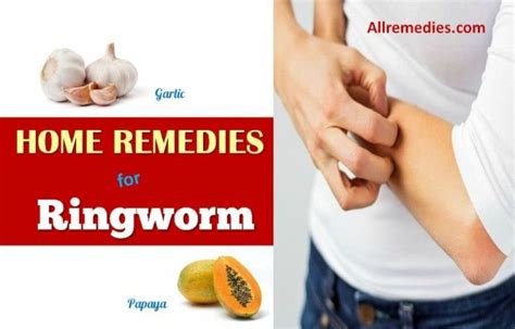 25 Natural Home Remedies for Ringworm in Humans