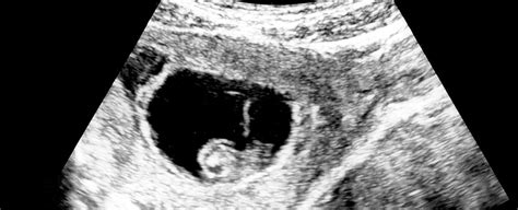 Is The 'Fetal Heartbeat' Detected at 6 Weeks Actually a Heartbeat? A ...