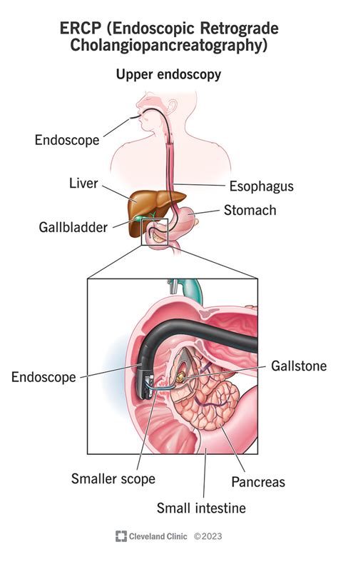 What You Should Know About ERCP (Endoscopic Retrograde , 42% OFF