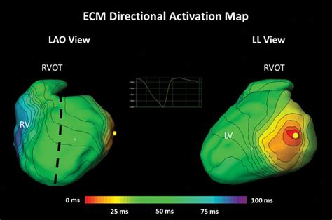 Confirmation of Novel Noninvasive High-Density Electrocardiographic ...