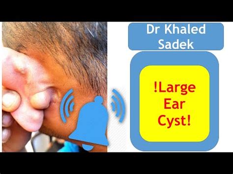 Massive multiple ear cyst Removed. Part 1 of 2 - BeHealthy