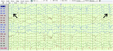 Postoperative electroencephalogram showing triphasic waves with... | Download Scientific Diagram