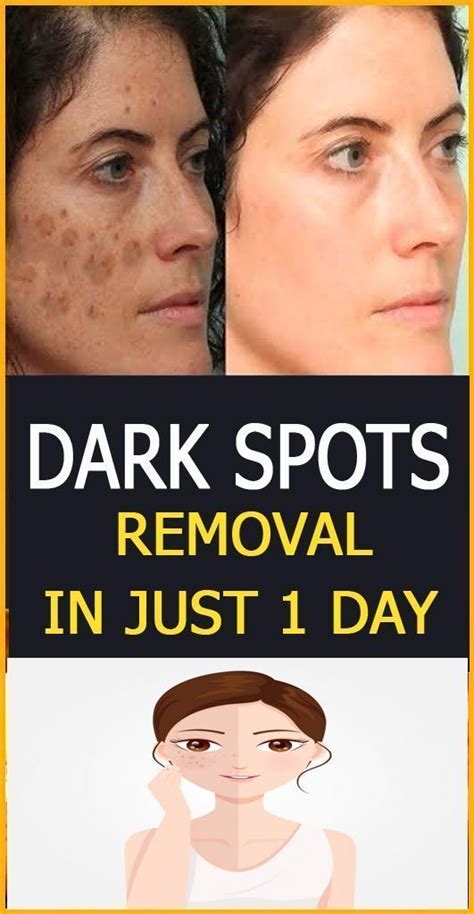 Natural Home Remedy To clear Your Skin Of Dark Spots Or Hyperpigmentation | Remove dark spots ...