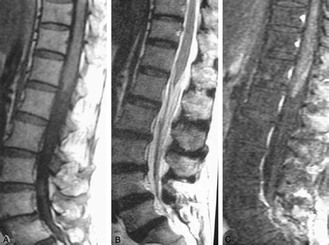 MR Imaging Findings in Cauda Equina Gnathostomiasis | American Journal ...