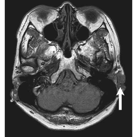 Photograph showing a lesion located on the cymba conchae at the second... | Download Scientific ...