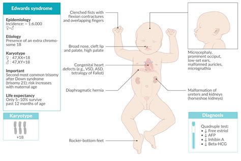 Edwards Syndrome Feet