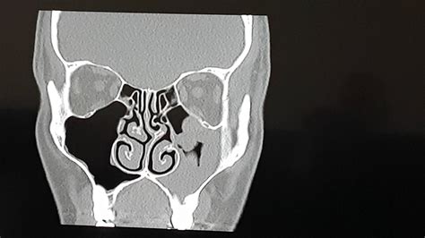 CT Scan, Sinuses 17th March 2017 - YouTube