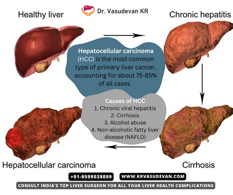 liver-diseases-what-is-liver-cirrhosis? - Dr Vasudevan K R