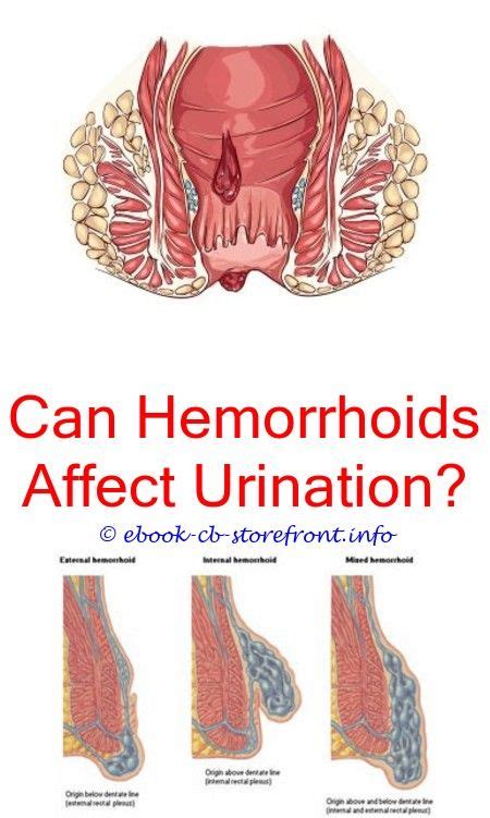 19+ Spectacular External Hemorrhoid Types Of Ideas