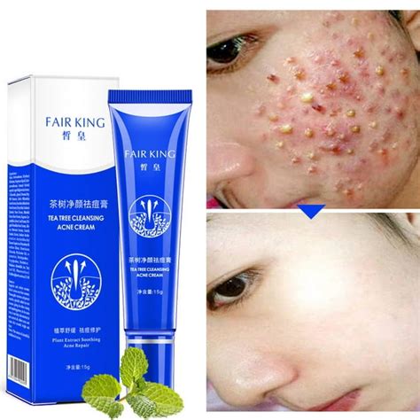 alextreme Cystic Acne Spot Cream Fast Acting Formula Cream for Clearing ...