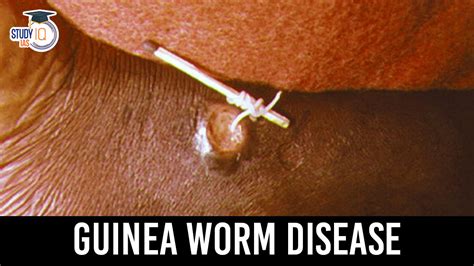 Guinea Worm Disease, Causes, Symptoms and Global Effort