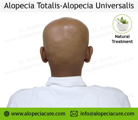 Alopecia Universalis