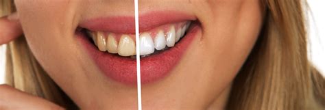 What is Carbamide Peroxide Teeth Whitening? - Dental Health Society